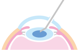 細いメスで、角膜（黒目）と強膜（白目）の境目に小さな創口を作ります。