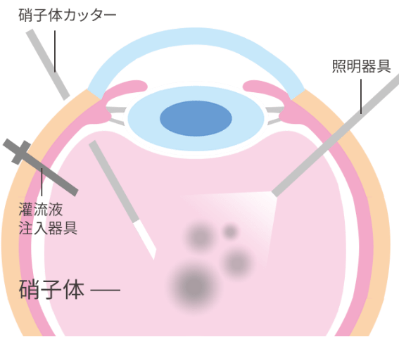 網膜硝子体手術